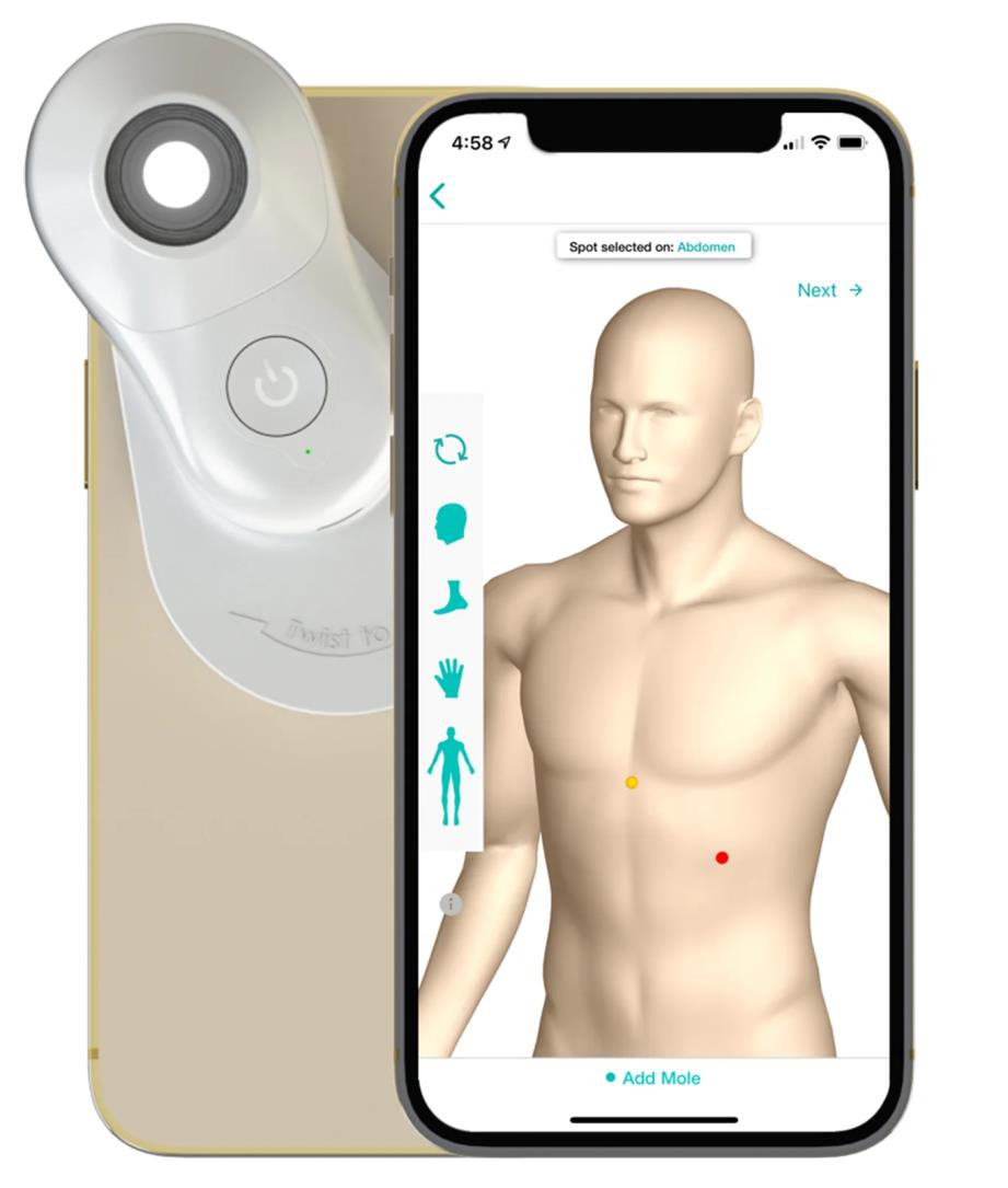 MoleScope II, Mobiele dermatoscoop