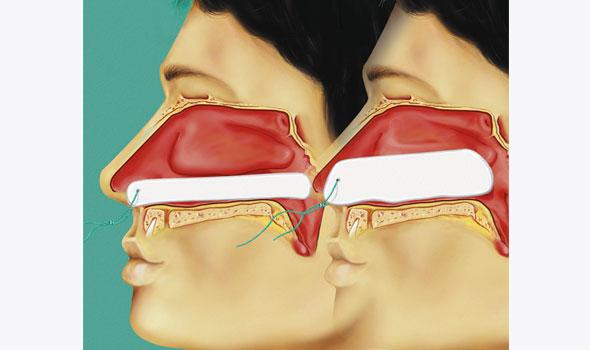 Neustampon, Raucocel, Zonder Ventilatiebuisje, Lohmann Rauscher