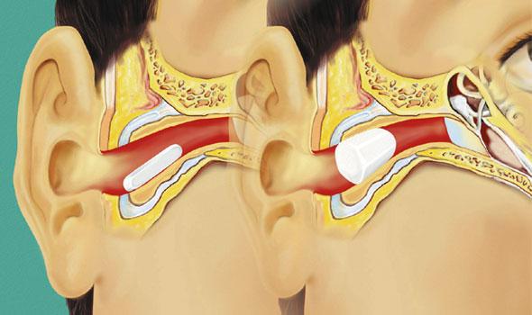 Oortampon, Roucocel, Met Touwtje, Lohmann Rauscher